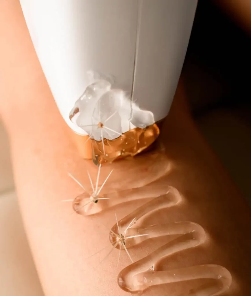 Application de gel pour epilation definitive laser - La Maison du Laser Granville