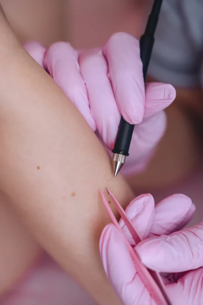 Epilation definitive electrolyse bras - La Maison du Laser Granville Manche